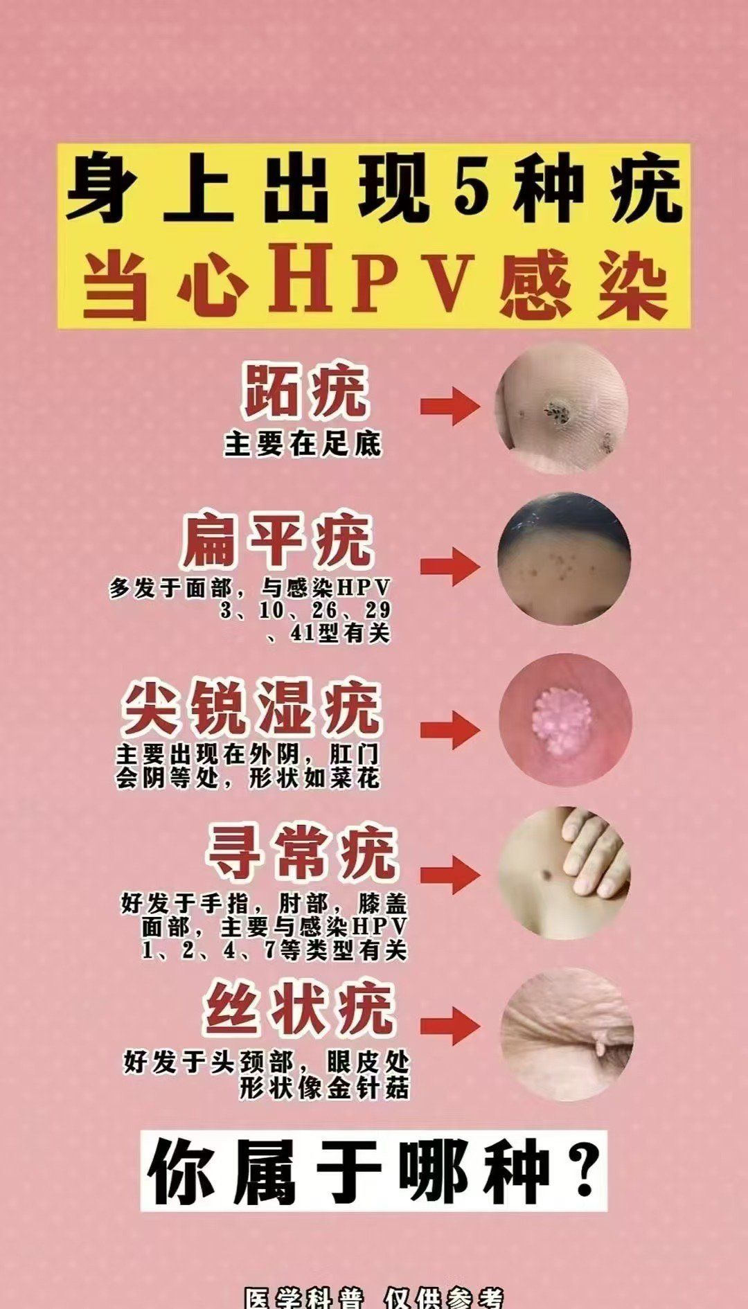 尖锐湿疣怎么治疗才能根治_(尖锐湿疣怎么治疗才能根治口腔) 第1张 尖锐湿疣怎么治疗才能根治_(尖锐湿疣怎么治疗才能根治口腔) 第1张