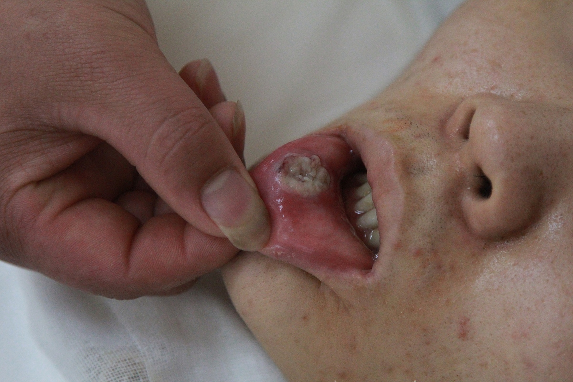 尖锐湿疣怎么治疗才能根治口腔_(尖锐湿疣怎么治疗才能根治口腔溃疡) 第2张 尖锐湿疣怎么治疗才能根治口腔_(尖锐湿疣怎么治疗才能根治口腔溃疡) 第2张