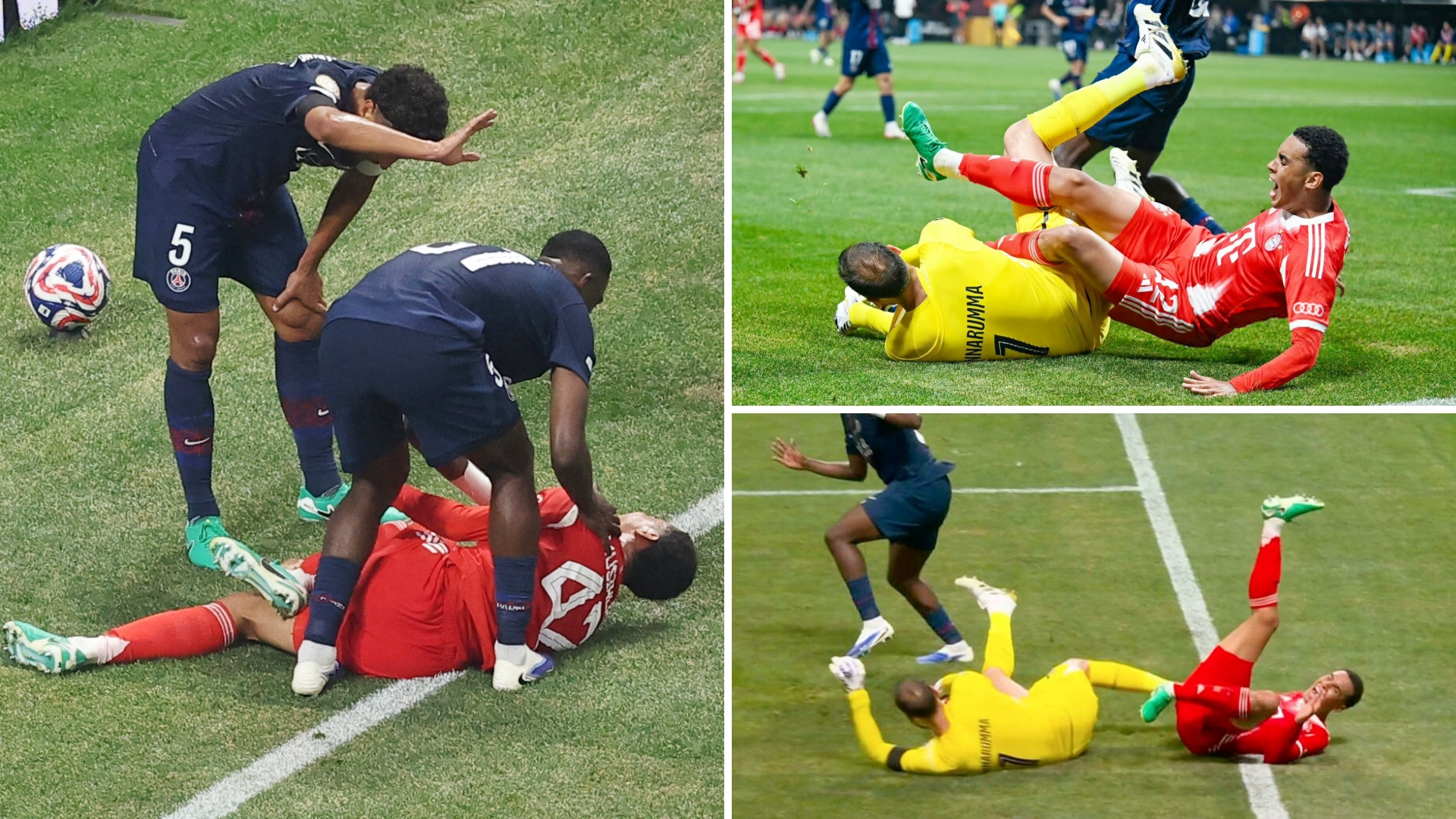 官方:穆西亚拉腓骨骨折且踝关节脱臼将接受手术治疗的简单介绍 第2张 官方:穆西亚拉腓骨骨折且踝关节脱臼将接受手术治疗的简单介绍 第2张